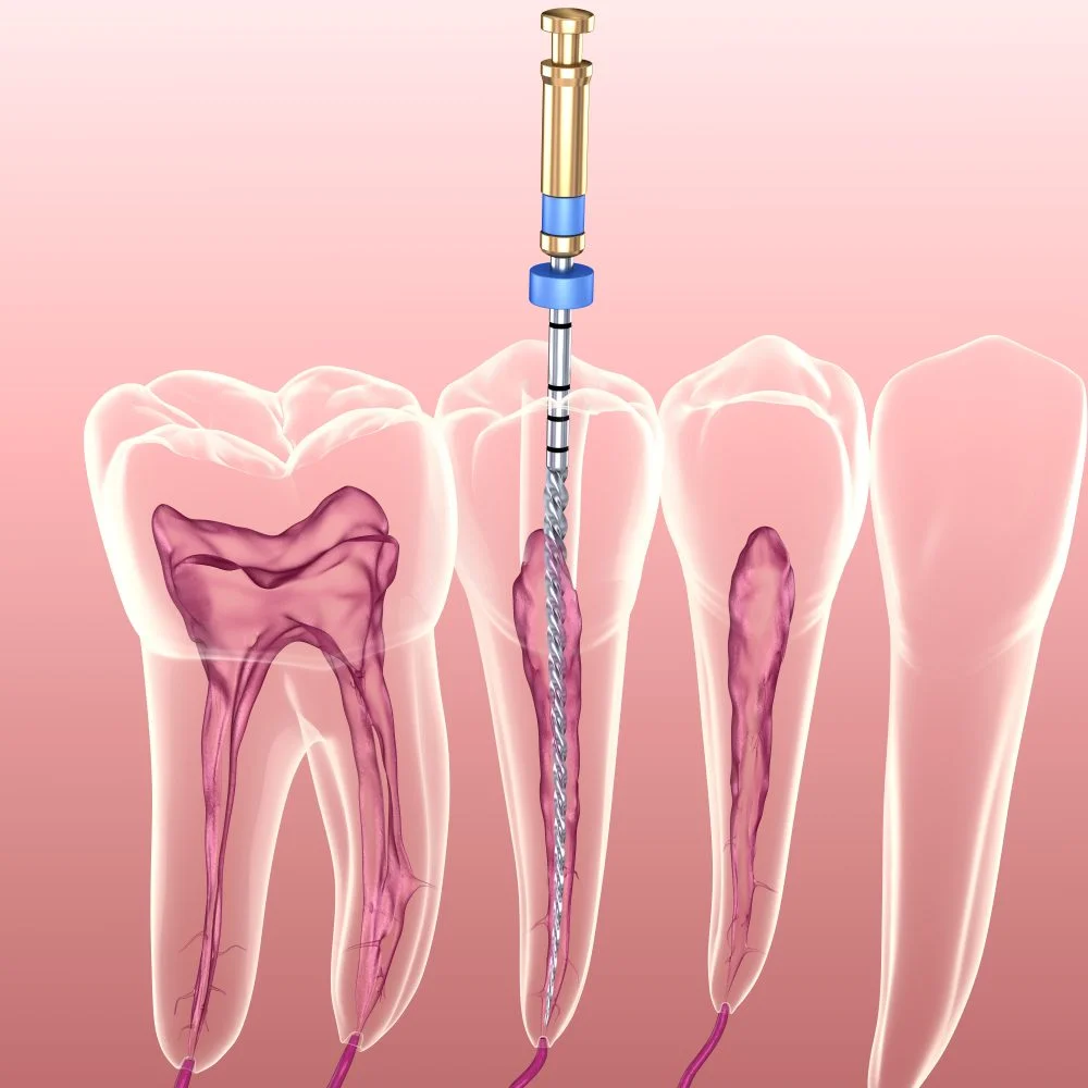 عصب کشی دندان چگونه است؟