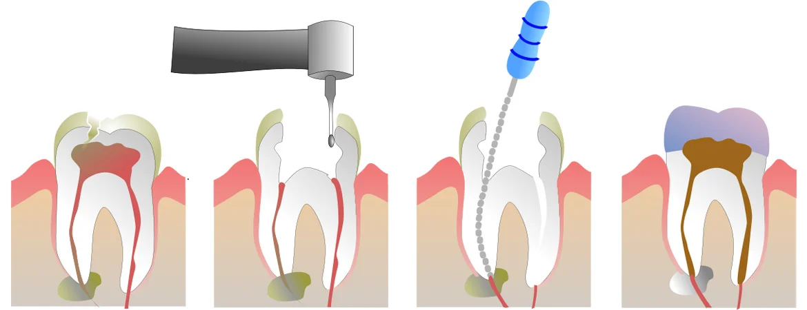 عصب کشی دندان چگونه است؟ 